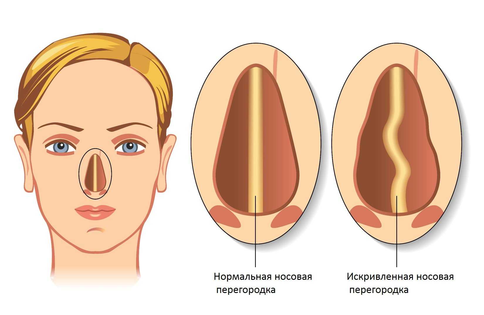 Неправильная перегородка носа