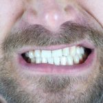 Бруксизм – почему появляется скрежет зубами и как от него избавиться