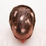 Алопеция: основные причины выпадения волос
