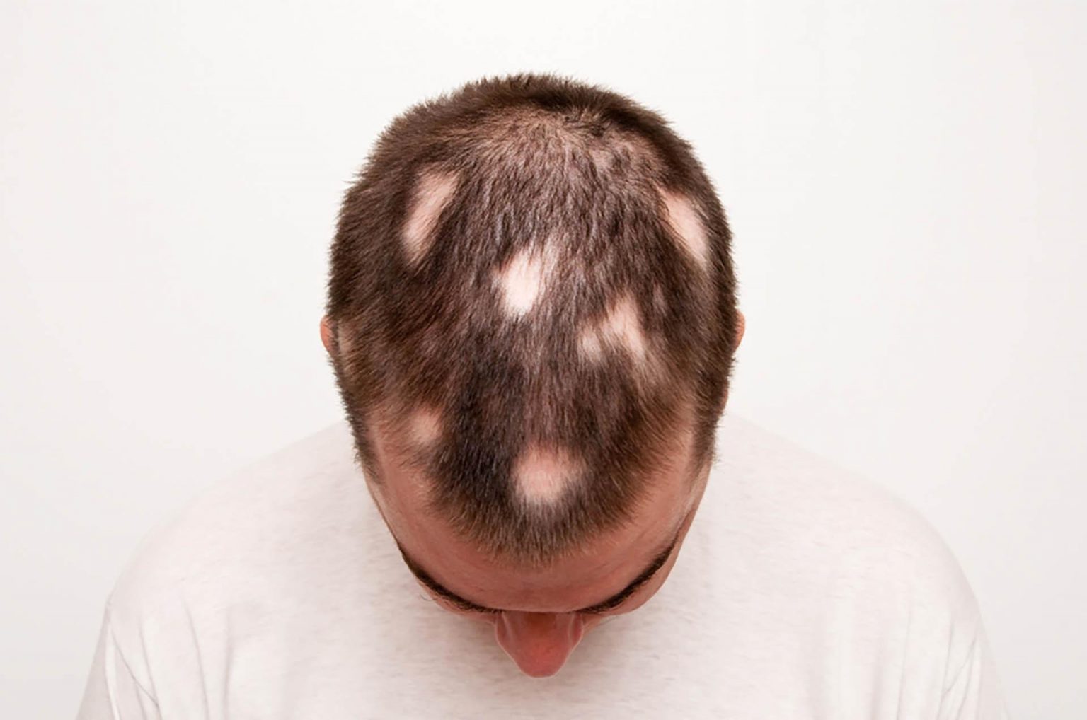 выпадение волос на груди у мужчин фото 115