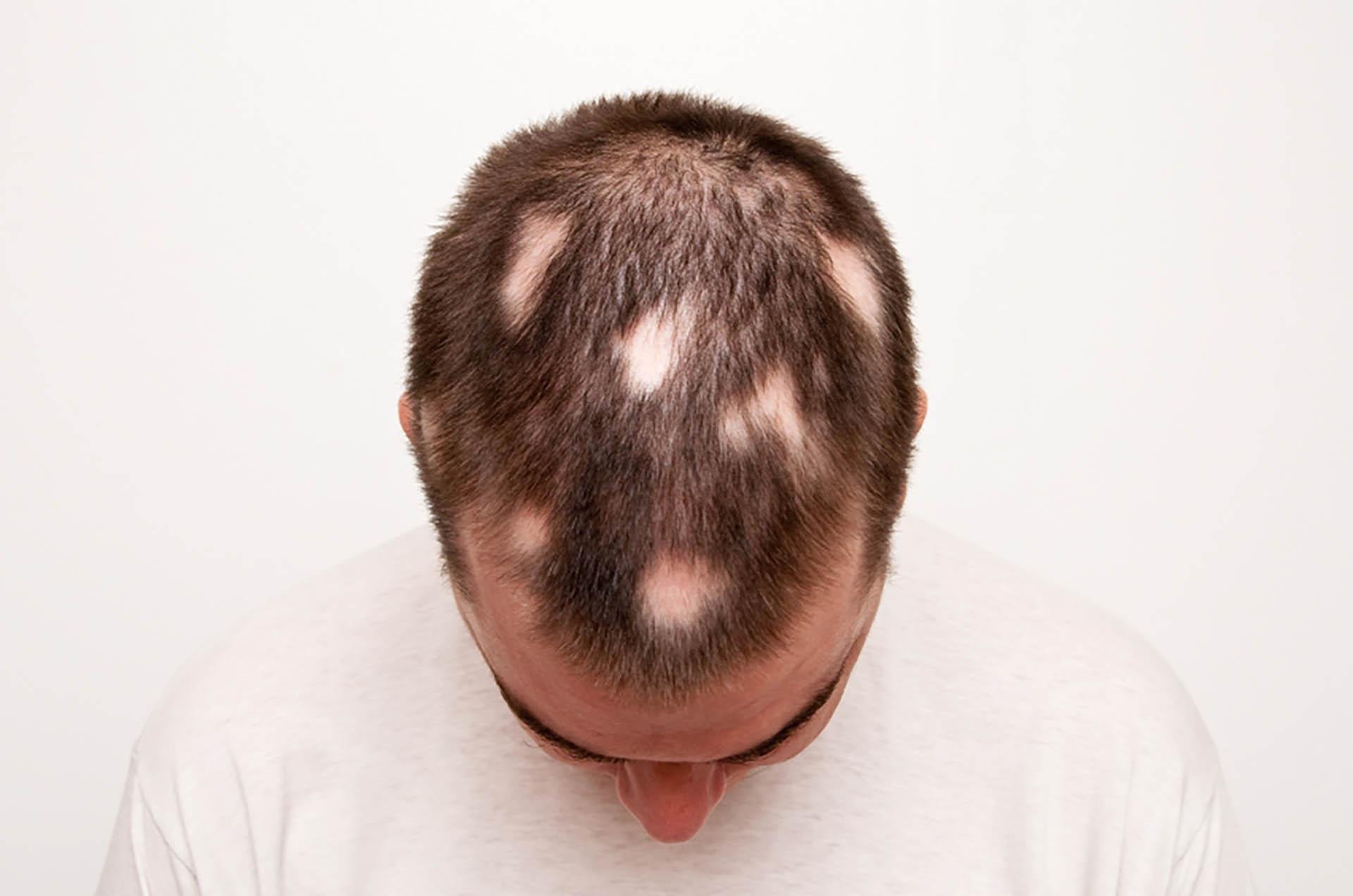 Волосы выпадают короткими. Очаговая алопеция (alopecia Areata). Очаговая (гнездная) алопеция. Андрогензависимая алопеция.