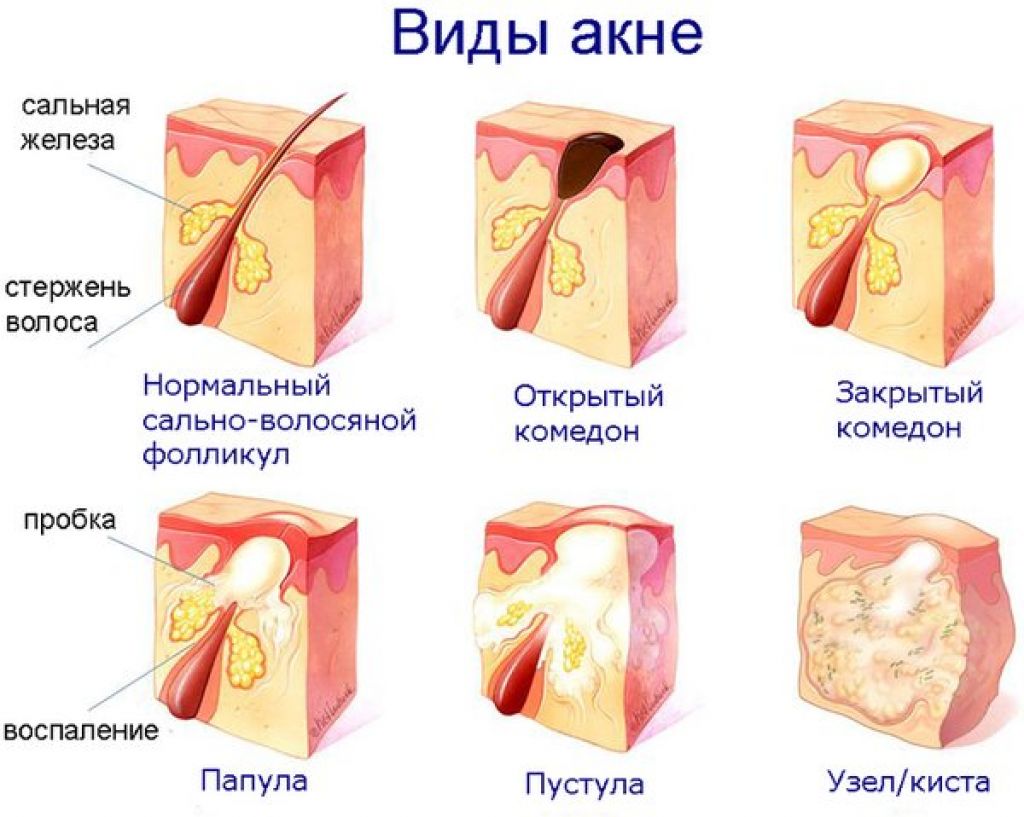 Акне виды