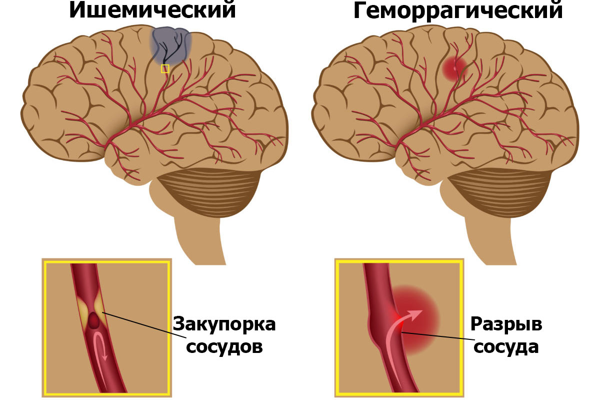 Виды инсульта