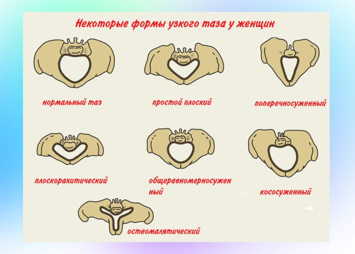 Кесарево сечение узкий таз