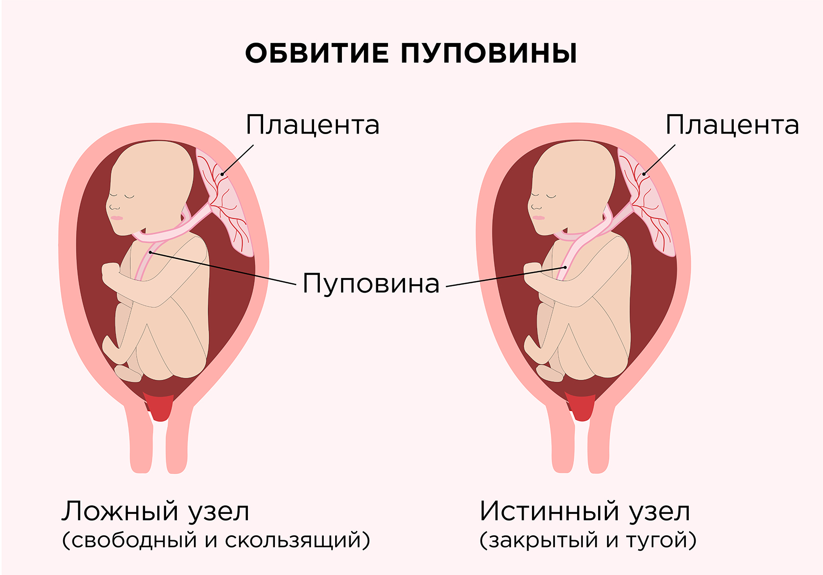 Кесарево сечение обвитие пупка