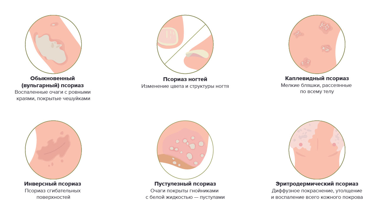 Псориаз виды