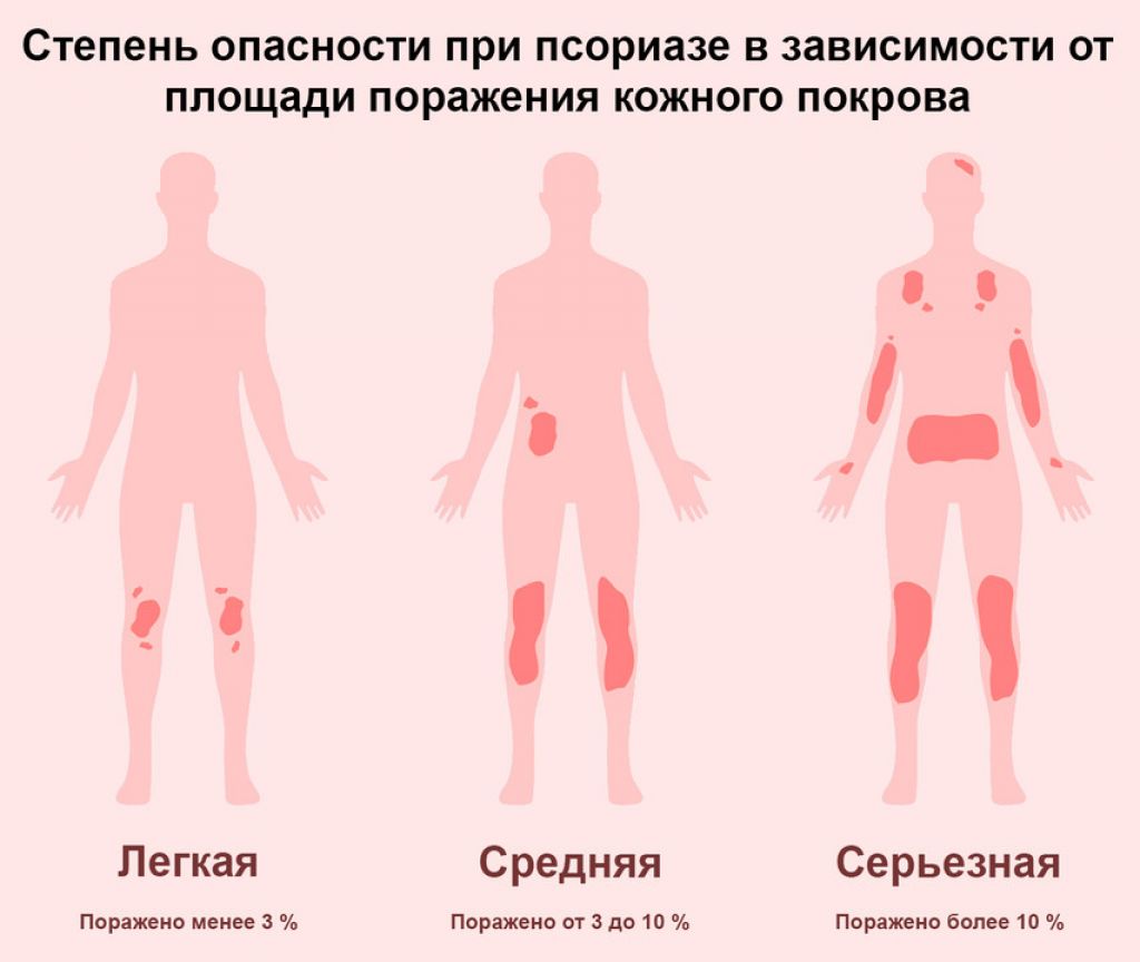 Степени тяжести псориаза