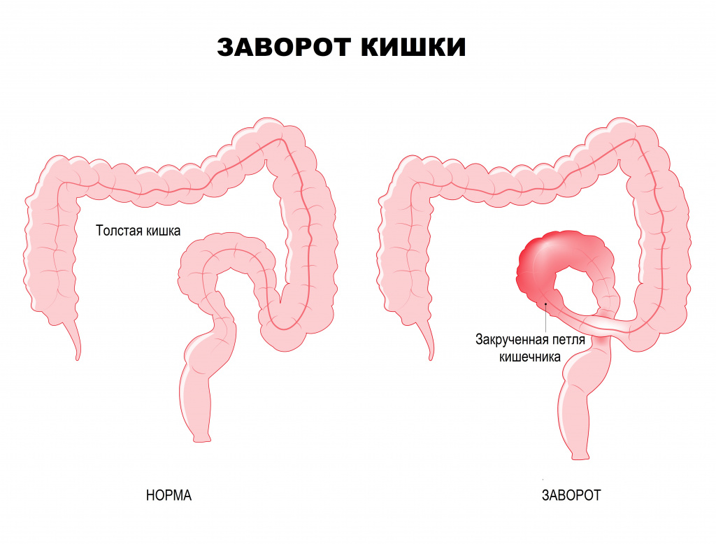 Осложнения при сальмонеллезе