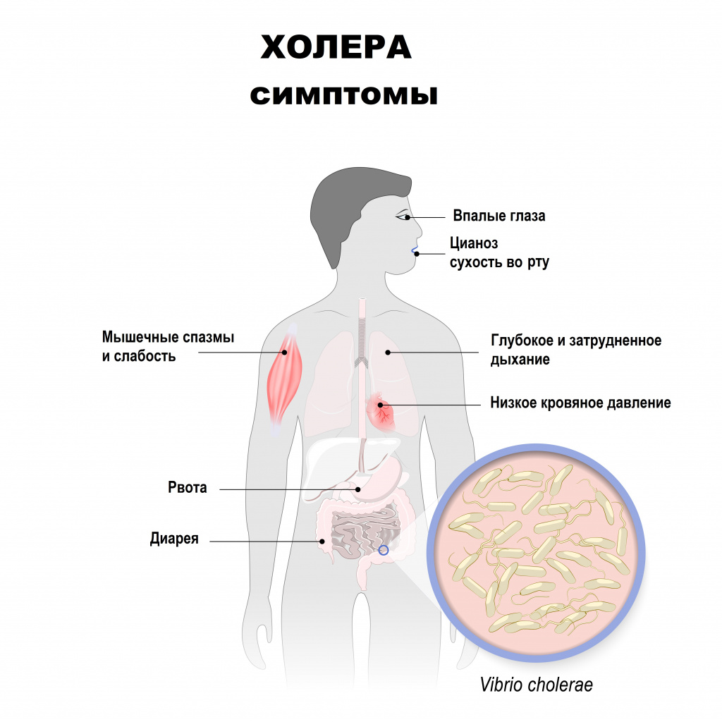Симптомы холеры