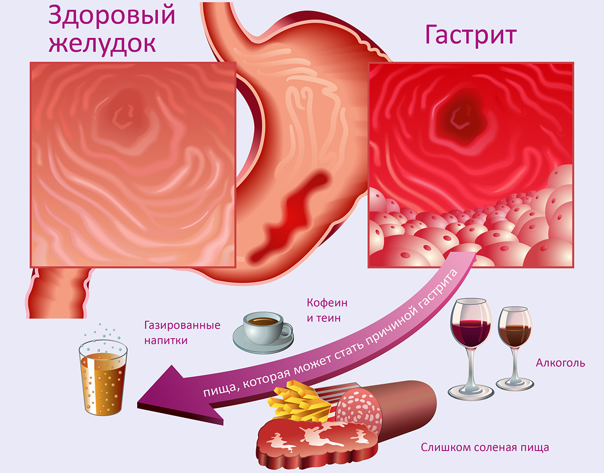 Гастрит и язва причины