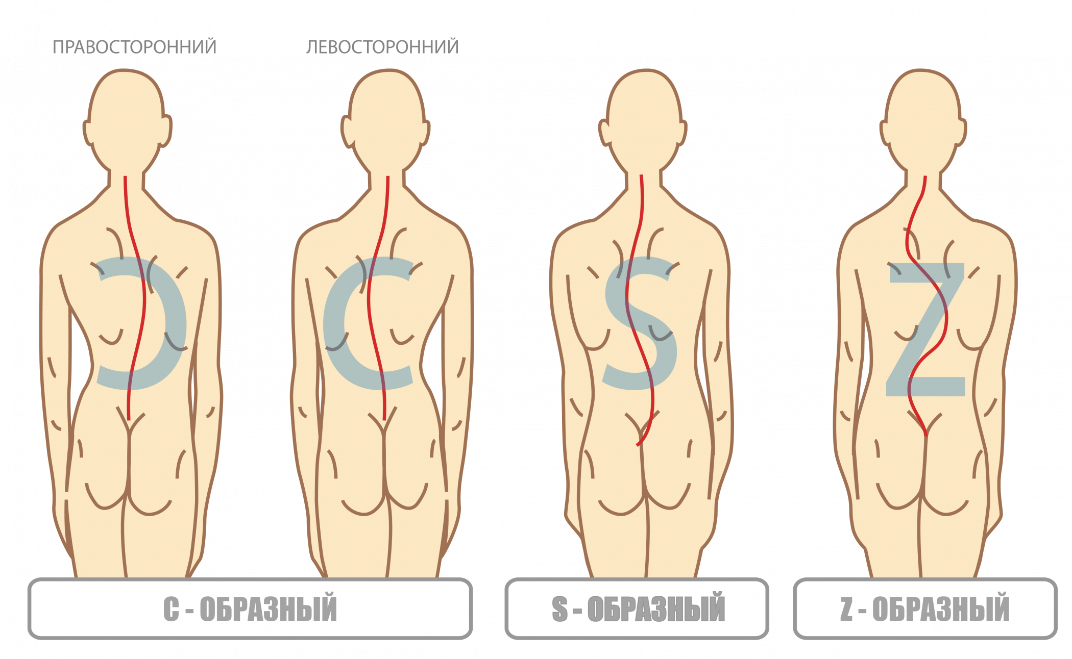 Форма сколиоза