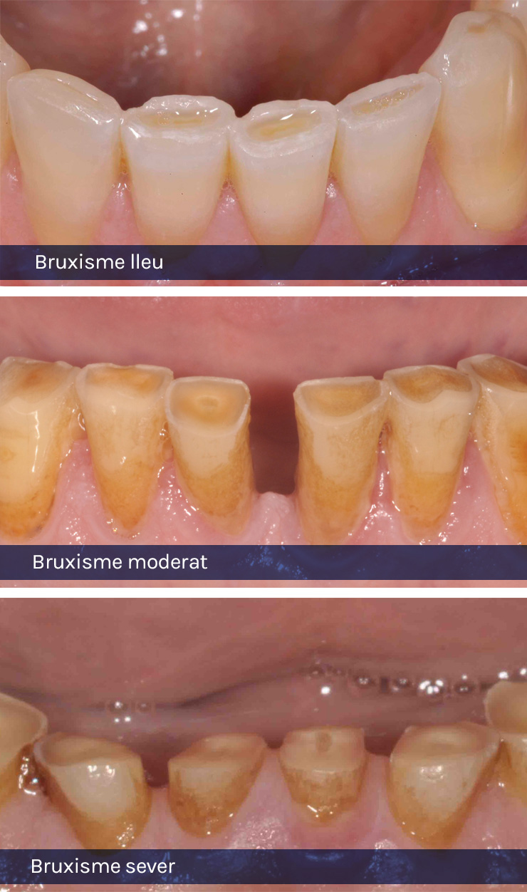 Стадии бруксизма