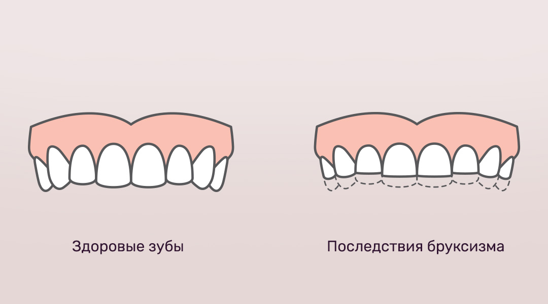 Последствия бруксизма